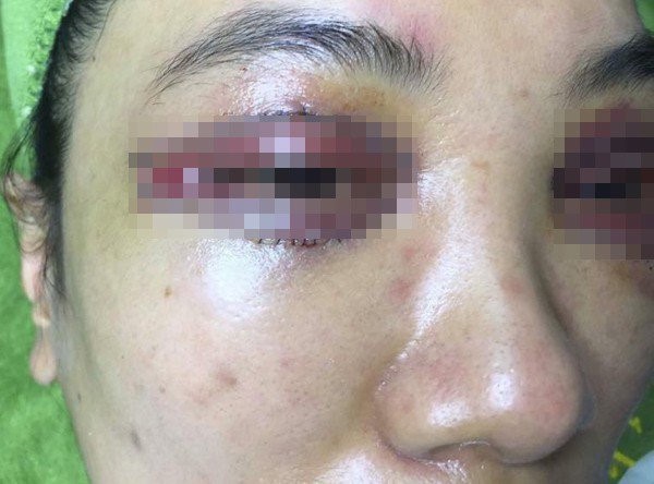 Khách hàng tố bệnh viện gây biến chứng sau khi phẫu thuật thẩm mỹ