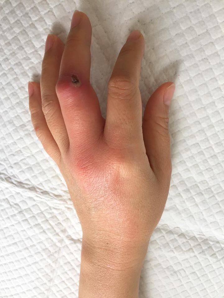 Chủ quan với vết xước lúc làm bếp, nhiễm trùng cả bàn tay