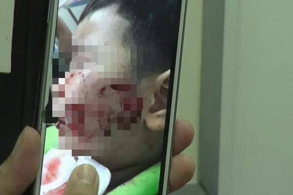 Bé trai 3 tuổi bị chó mới đẻ của trường mầm non cắn nhập viện