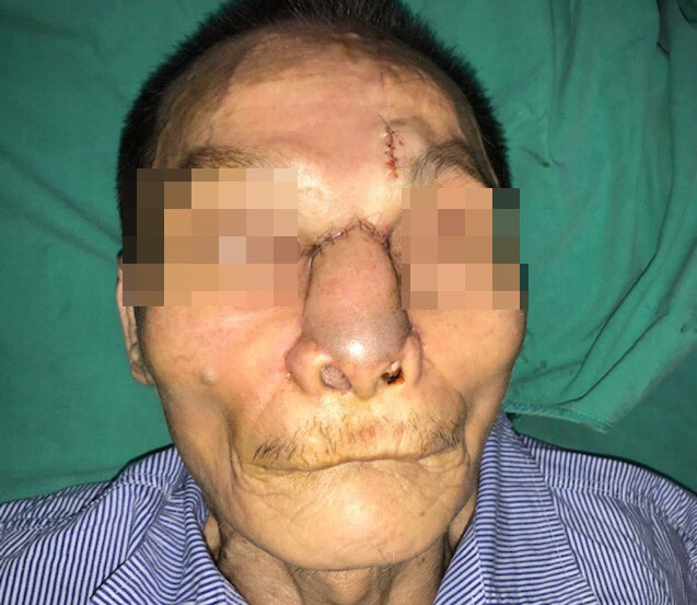 Một nam giới bị khoét sạch mũi, má vì ung thư da