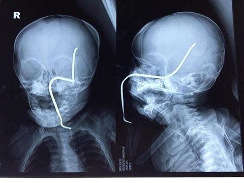 Bé gái 8 tháng tuổi đang chơi bị thanh sắt đâm xuyên sọ