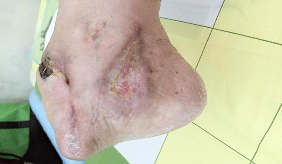 Giẫm gai, mất luôn nửa bàn chân