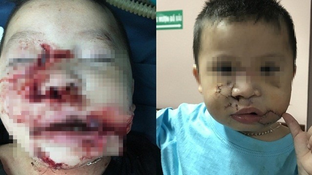 Đang chơi với chó con, bé trai 2 tuổi bị chó mẹ cắn nát mặt