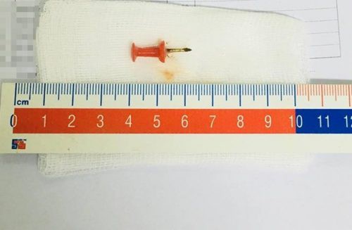 Chơi với em, bé gái 12 tuổi suýt chết vì nuốt phải đinh ghim