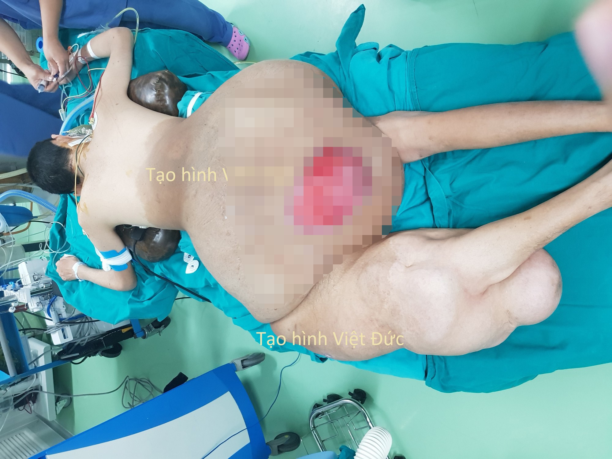 Bác sĩ "choáng" với khối u nặng 45 kg trên người nam thanh niên