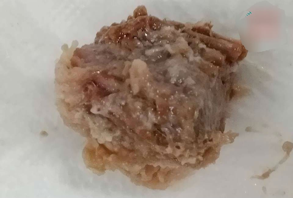 Ăn bún bò, bị cục gân bò 5 cm chắn đường thở