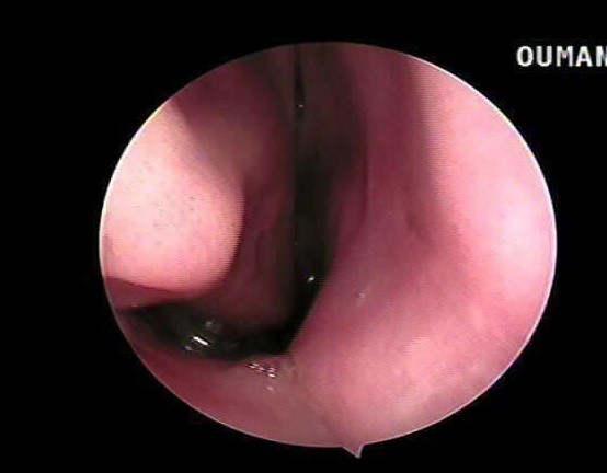 2 con vắt sống trong mũi cụ b&agrave; v&agrave; b&eacute; trai 8 tuổi gần 1 th&aacute;ng - Ảnh 1.