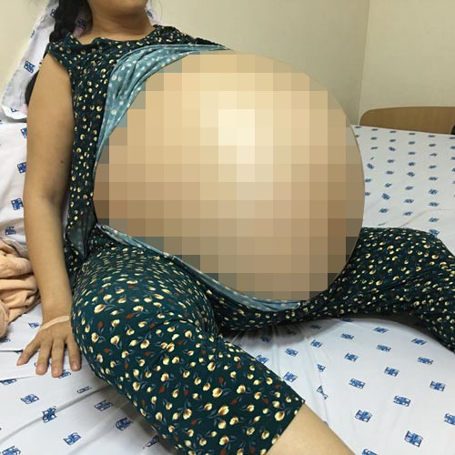 Hiểm họa u nang chuyển sang ác tính
