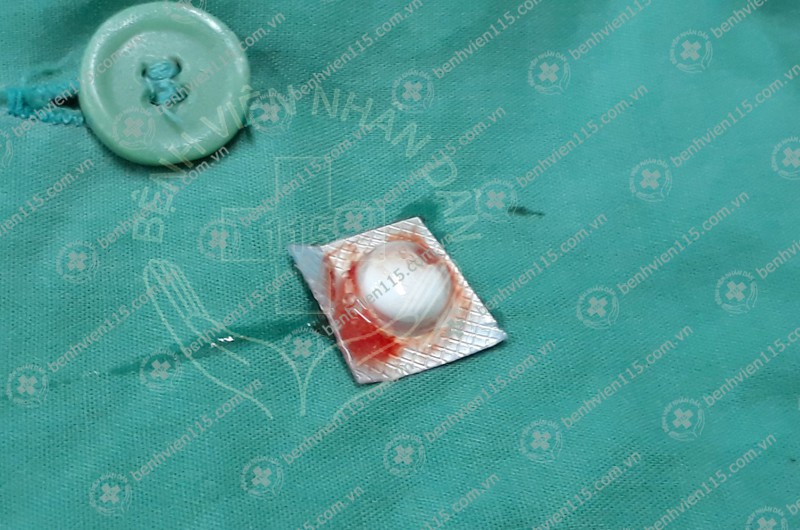 Uống cả vỏ thuốc, người đ&agrave;n &ocirc;ng li&ecirc;n tục ho ra m&aacute;u - Ảnh 1.