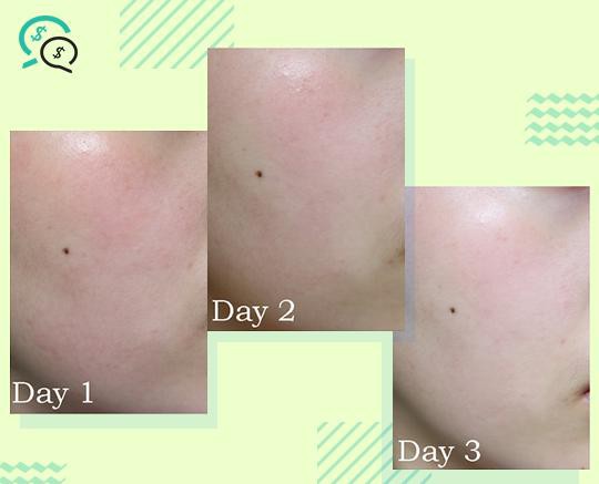 Phục hồi l&agrave;n da với ampoule rau m&aacute; trị mụn v&agrave; l&agrave;m mờ th&acirc;m - Ảnh 6.