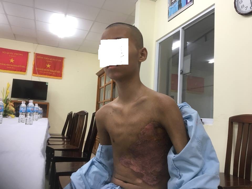 Bị xe buýt tông, 1 bé trai dập phổi và gãy 5 xương sườn