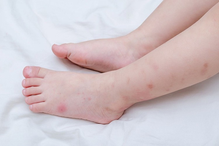 5 mẹo trị sẹo th&acirc;m do muỗi đốt kh&ocirc;ng để lại dấu vết - Ảnh 1.