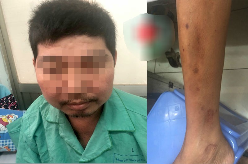 Uống thuốc Đông y "ngậm" corticoid, người đàn ông "to không đều"