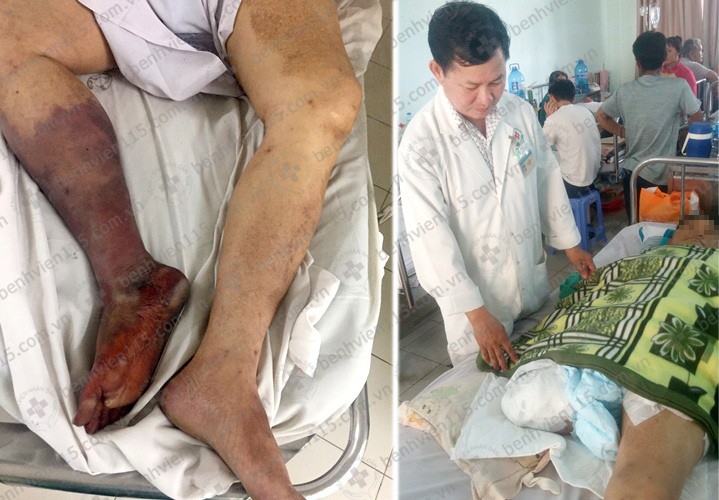 Bị cắt cụt chân do uống thuốc không đều