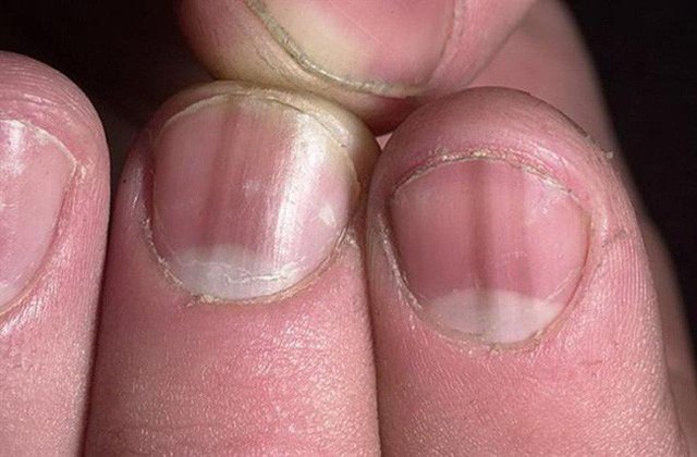 Nhìn móng tay, biết ngay bạn mắc bệnh gì