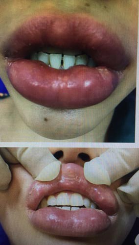 Kinh hoàng làm đẹp bằng filler - Ảnh 1.