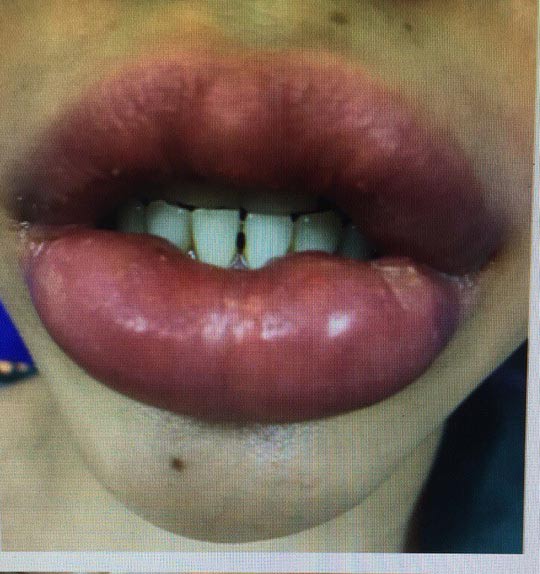 Kinh hoàng làm đẹp bằng filler
