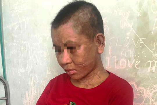 Một phụ nữ nghi bị chủ tra tấn man rợ đến "thân tàn ma dại"