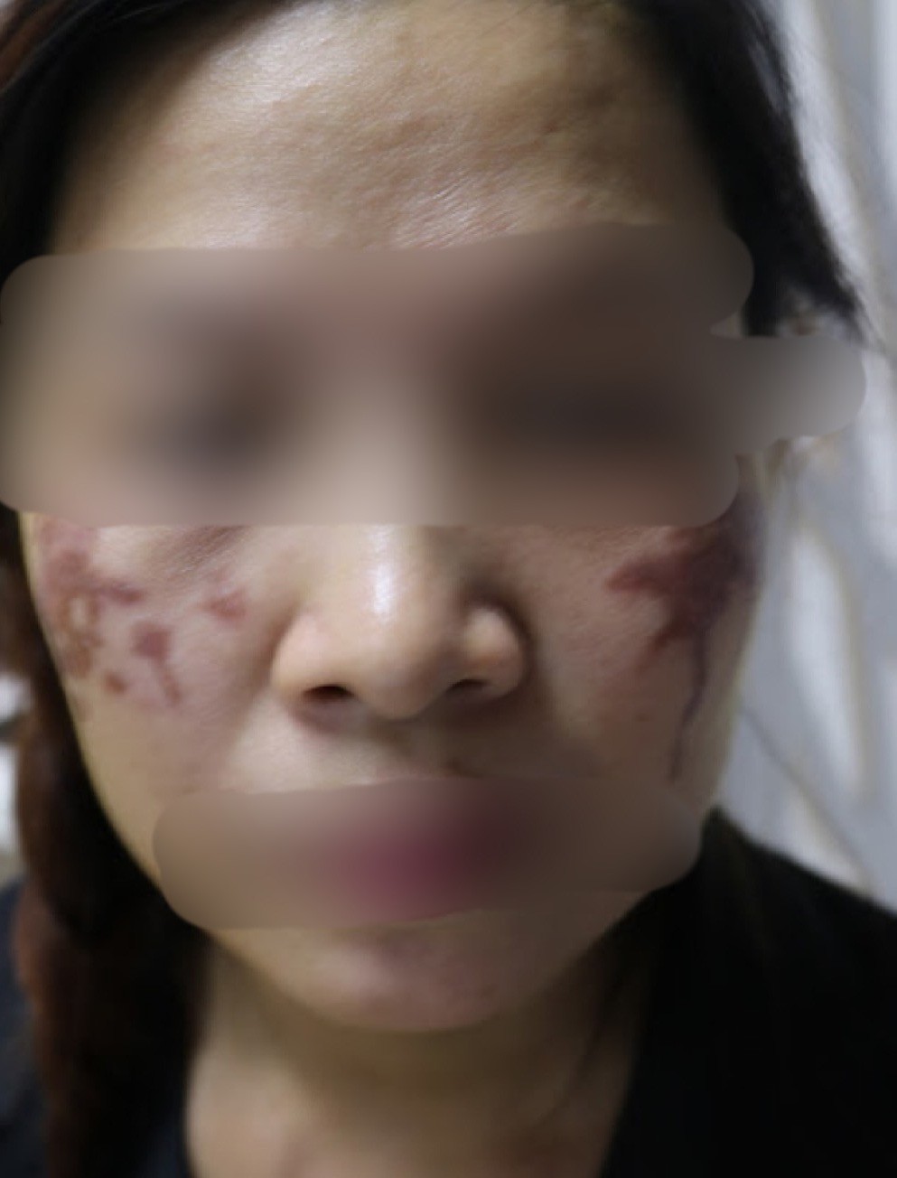 Mặt loang lổ sạm đen v&igrave; chấm axit chữa n&aacute;m da - Ảnh 1.