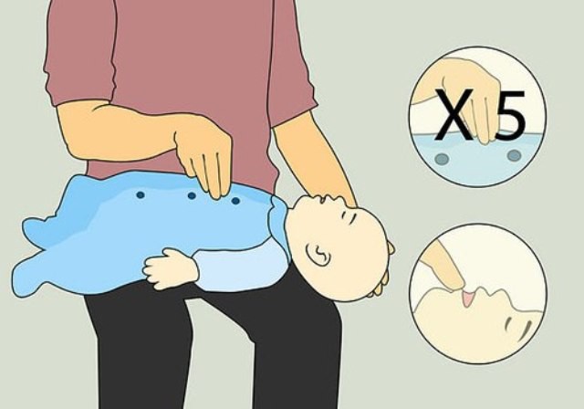 Bác sĩ chỉ cách sơ cứu khi trẻ bị hóc dị vật
