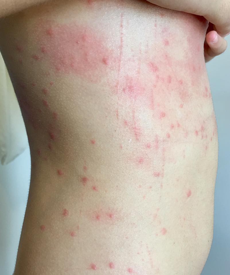 Tắm biển Đ&agrave; Nẵng bị ngứa nổi đốm đỏ cả người? - Ảnh 1.