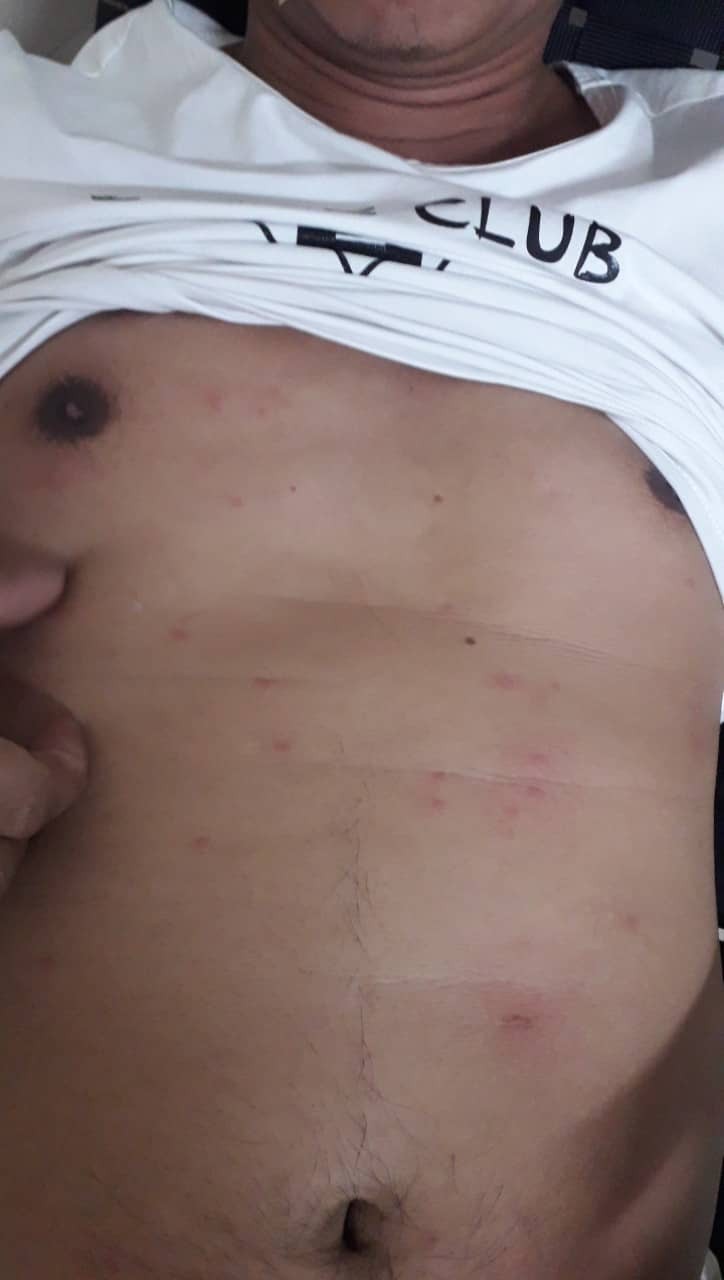 Tắm biển Đ&agrave; Nẵng bị ngứa nổi đốm đỏ cả người? - Ảnh 2.