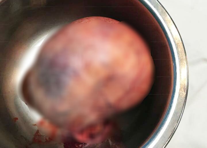 Mang khối u sợ cắt, một phụ nữ su&yacute;t chết - Ảnh 2.