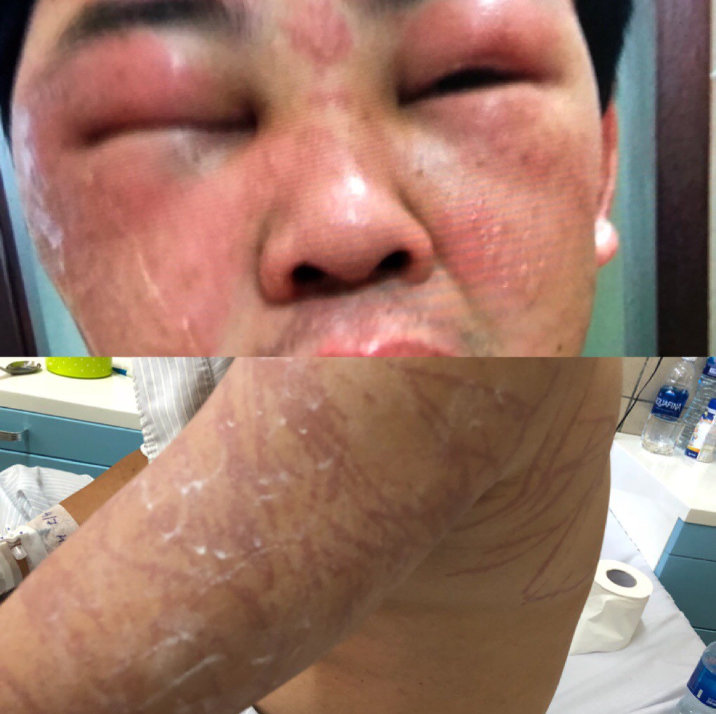 Lặn, "tông" vào sứa biển, du khách chằng chịt thương tích