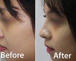 Ti&ecirc;m filler n&acirc;ng mũi, một phụ nữ bị biến chứng - Ảnh 2.