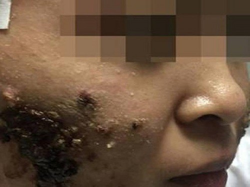Kinh ho&agrave;ng mụn trứng c&aacute; dầy cơm ch&aacute;y sau khi đi spa - Ảnh 1.