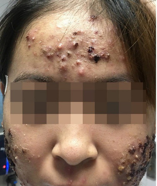 Kinh hoàng mụn trứng cá dầy cơm cháy sau khi đi spa