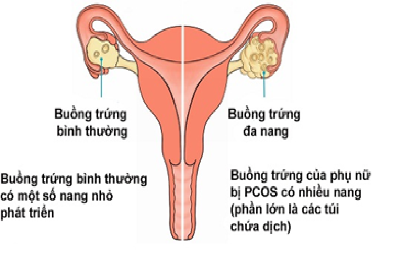Bị buồng trứng đa nang l&agrave; sẽ v&ocirc; sinh? - Ảnh 1.