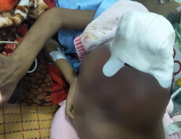 Đắp thuốc trôi nổi, mụn nhỏ thành khối u ác tính che kín mặt bé trai