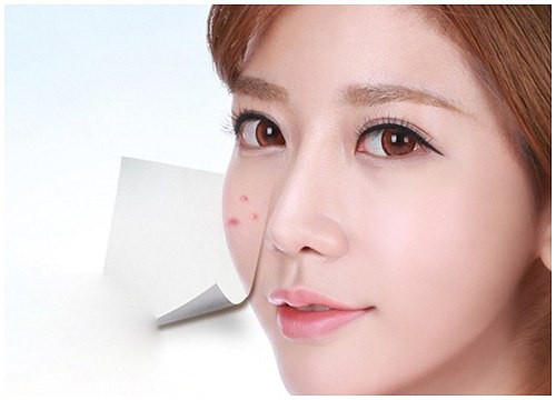 Nguy hại khôn lường khi nặn mụn đầu đen