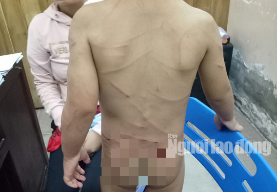 Giải cứu bé trai 3 tuổi bị cha dượng đánh dã man ở Phú Quốc