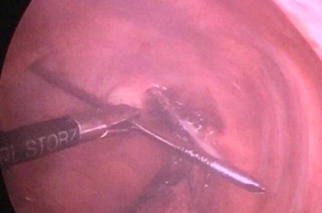Hy hữu, người đ&agrave;n &ocirc;ng &ldquo;sống khoẻ&rdquo; d&ugrave; đinh 12 cm xuy&ecirc;n qua phổi, tuỷ - Ảnh 2.