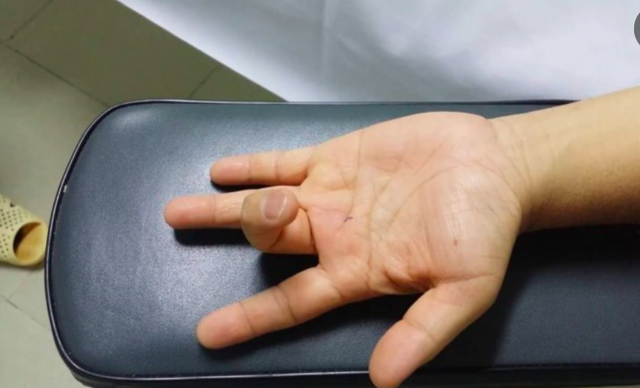 Ai dễ mắc bệnh lý ngón tay lò xo?