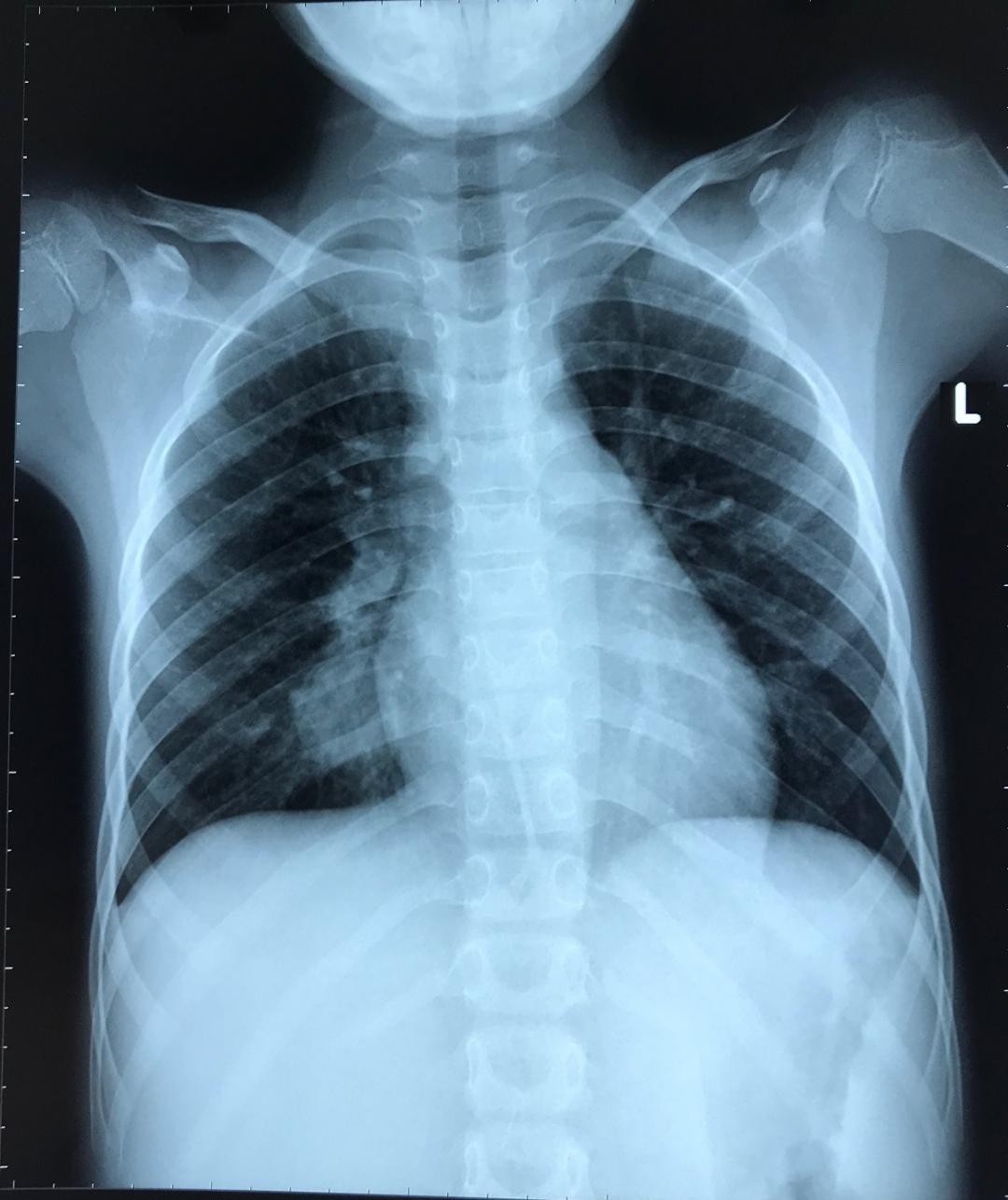 Qua 3 bệnh viện, ca bệnh phổi hiếm gặp được cứu