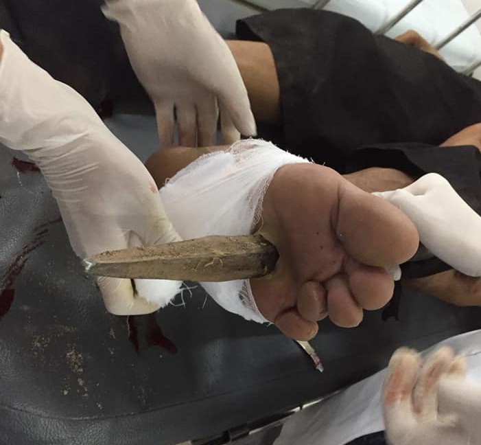 Xà beng "trên trời" rơi xuống xuyên thấu chân người đàn ông