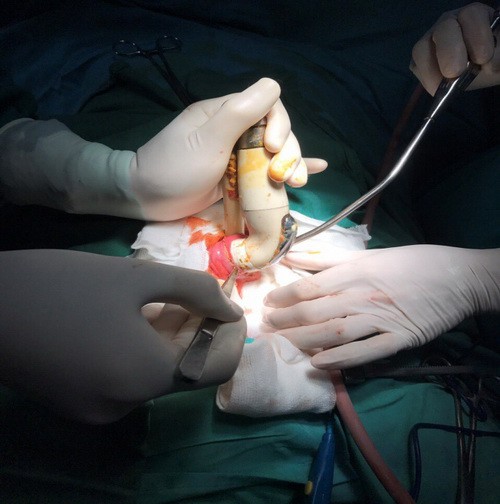 Rửa vệ sinh, nam thanh niên bị đầu vòi xịt bồn cầu lọt sâu vào hậu môn