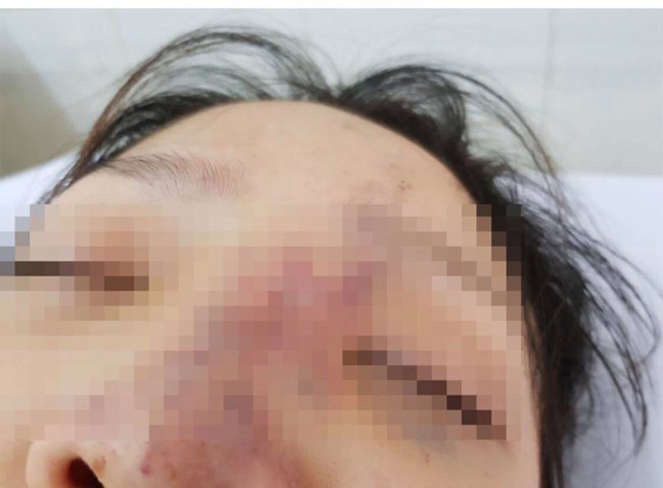 Một nữ sinh có nguy cơ mù mắt vì tiêm filler