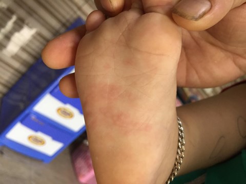 Cảnh báo tay chân miệng, dấu hiệu cha mẹ đừng bỏ qua