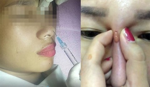 M&ugrave; mắt v&igrave; l&agrave;m đẹp bằng filler nhưng nhiều người vẫn liều mạng - Ảnh 1.
