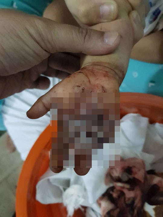 Bé trai vào viện với chiếc thùng lạnh đựng bàn tay - Ảnh 1.
