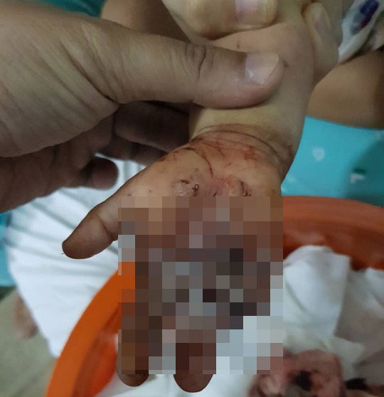 Bé trai vào viện với chiếc thùng lạnh đựng bàn tay
