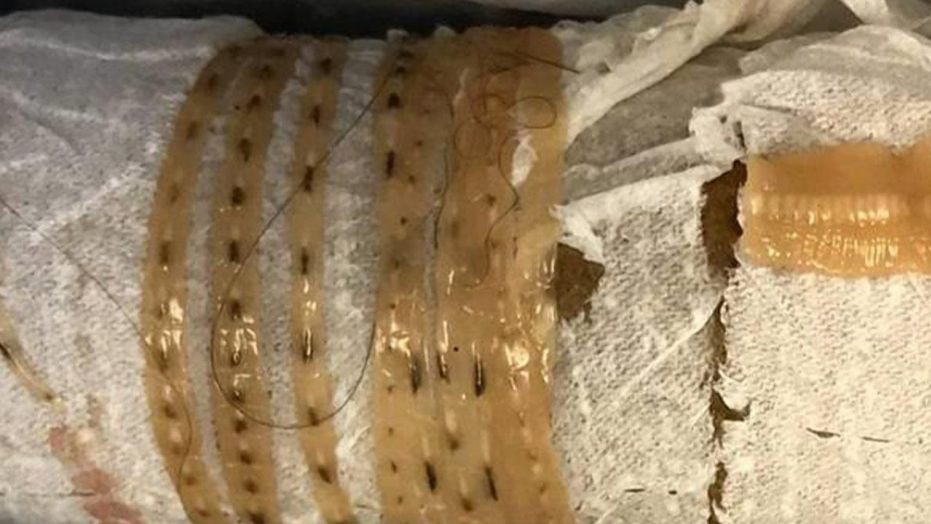 Mỹ: Ăn sushi hàng ngày, kéo ra giun dài hơn 1,6 m