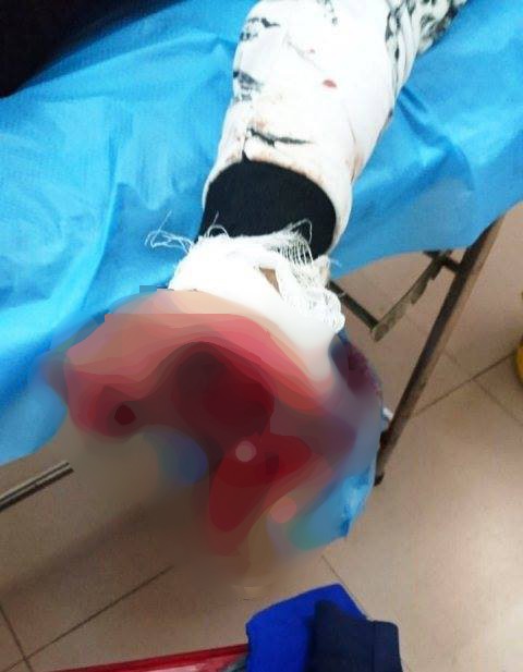 Vừa sạc vừa d&ugrave;ng điện thoại, thiếu ni&ecirc;n 17 tuổi bị n&aacute;t b&agrave;n tay - Ảnh 1.
