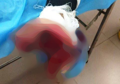 Vừa sạc vừa dùng điện thoại, thiếu niên 17 tuổi bị nát bàn tay