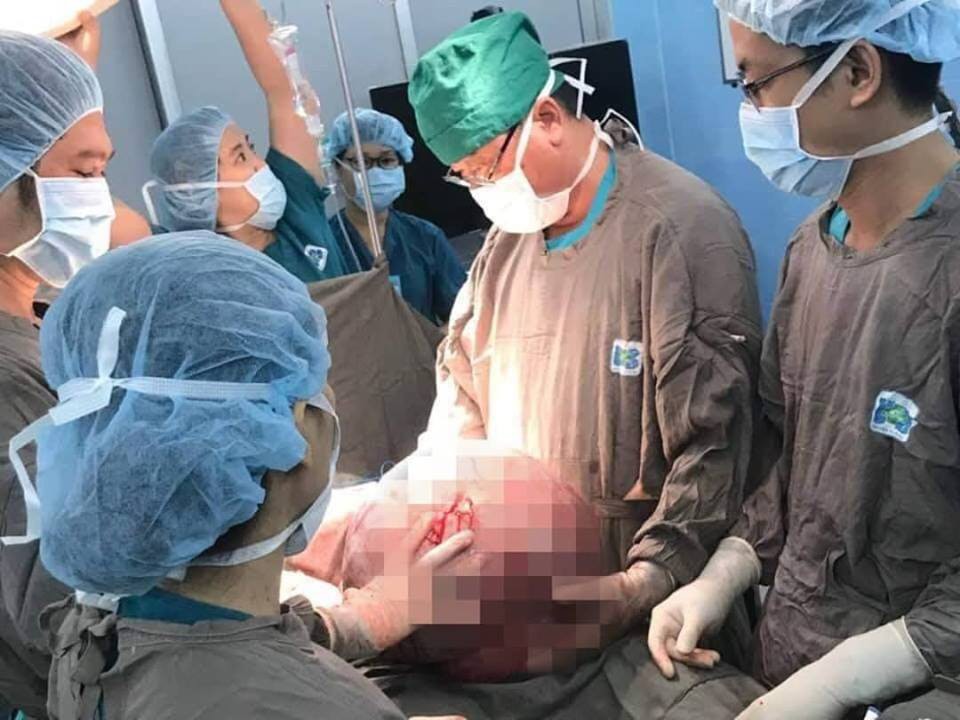 Người phụ nữ mang khối u buồng trứng đến 20 kg