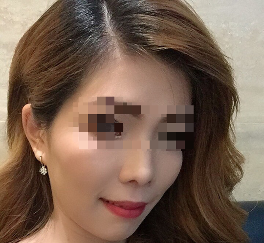 Mở băng sau cắt hàm, nữ công nhân không tin vào gương mặt mình